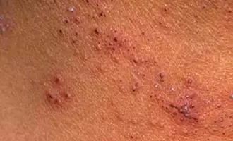 meerdere papillomen op de huid