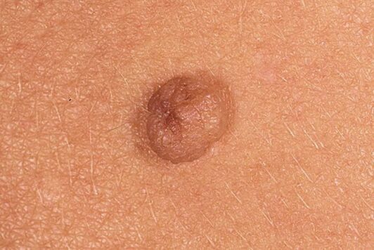 Eenvoudig papilloma