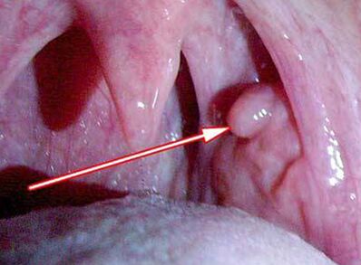 Papilloma in het strottenhoofd