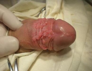 Papilloma op een lid