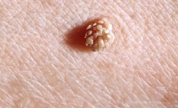 Papilloma op het menselijk lichaam