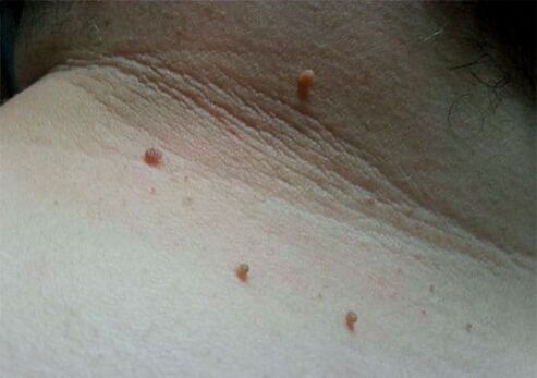 Papilloma's in de nek