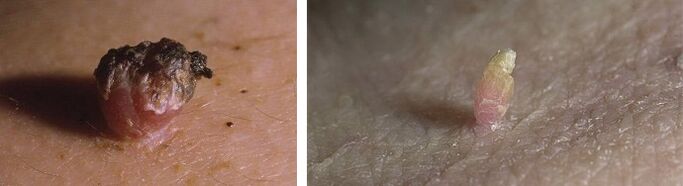 Papilloma's op de huid