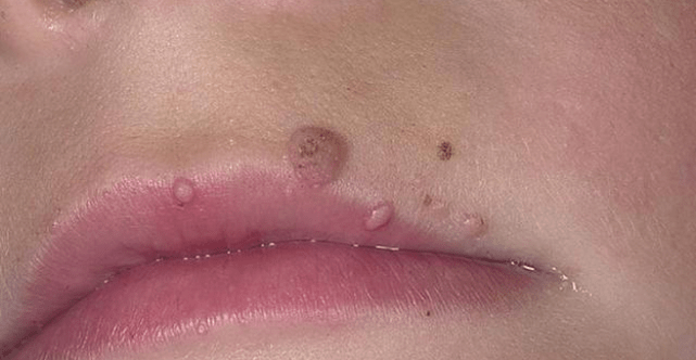Papilloma's op de lippen